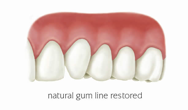 Treatment of gum recession